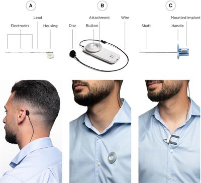 Minimally invasive surgery for placement of a subcutaneous EEG implant
